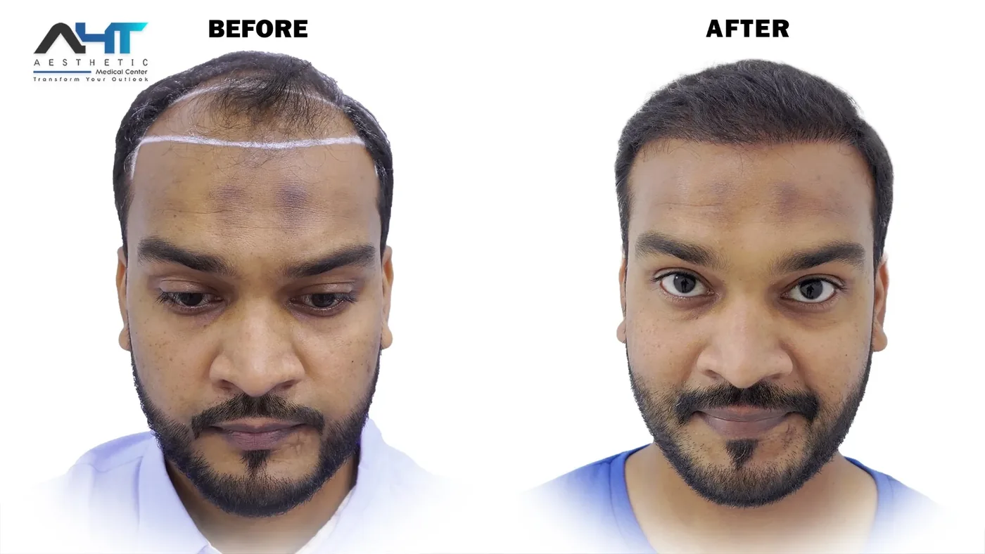 AHT Patient Result 9 before and after