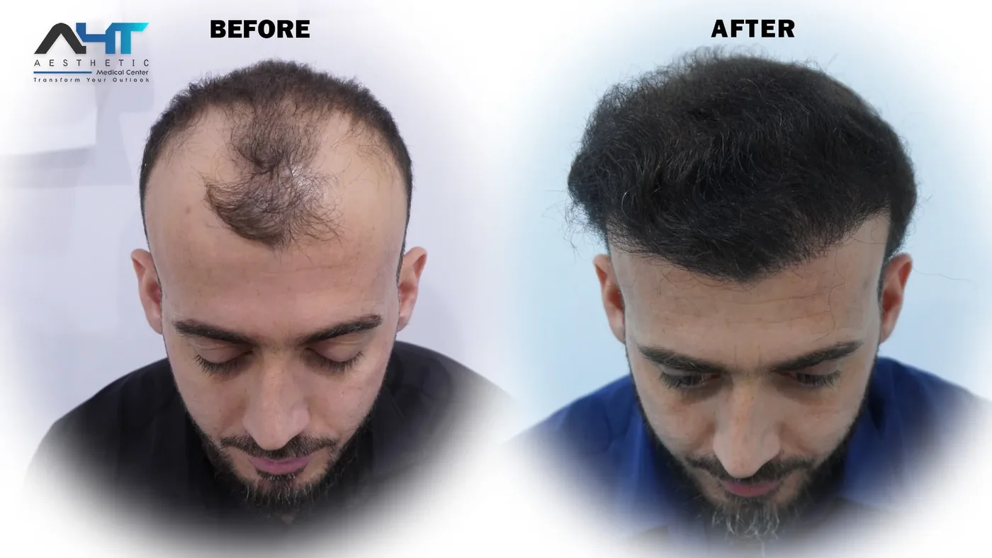 AHT real patient hair transplant result 1