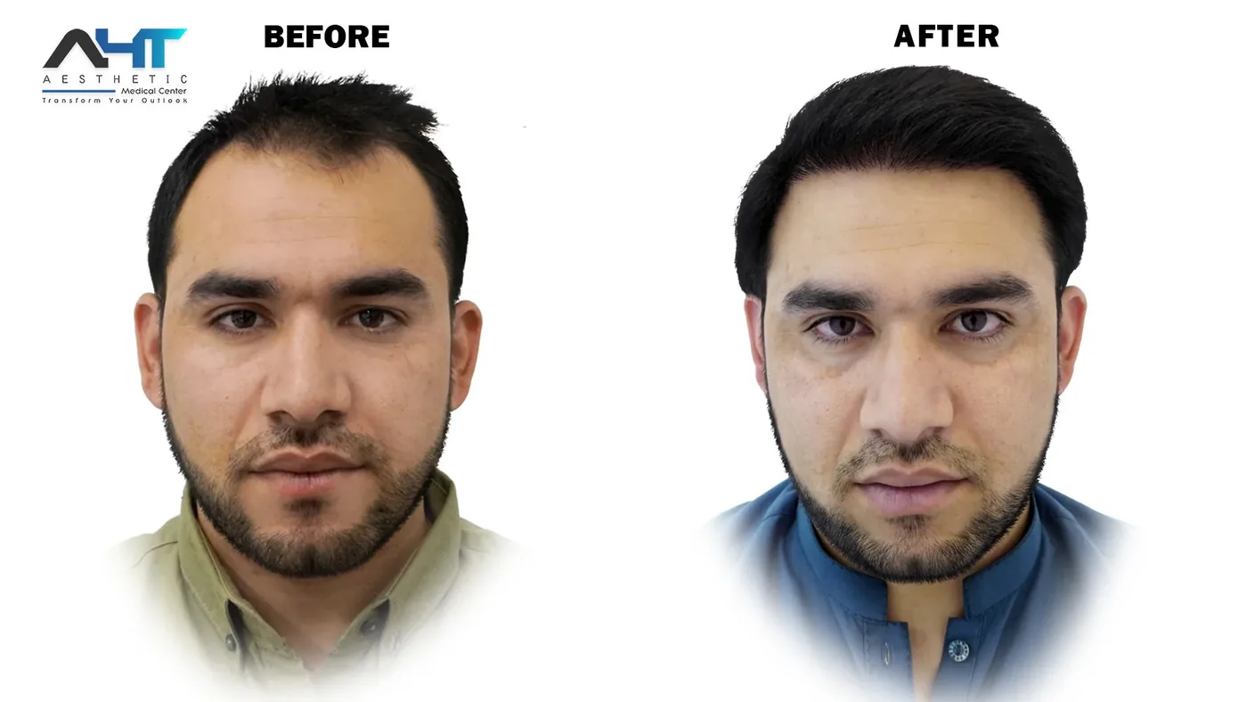 AHT real patient hair transplant result 2