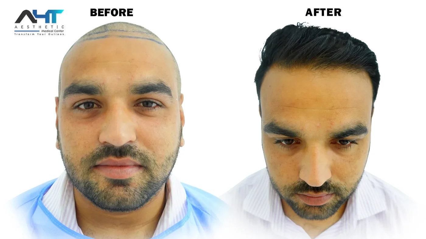 AHT real patient hair transplant result 3
