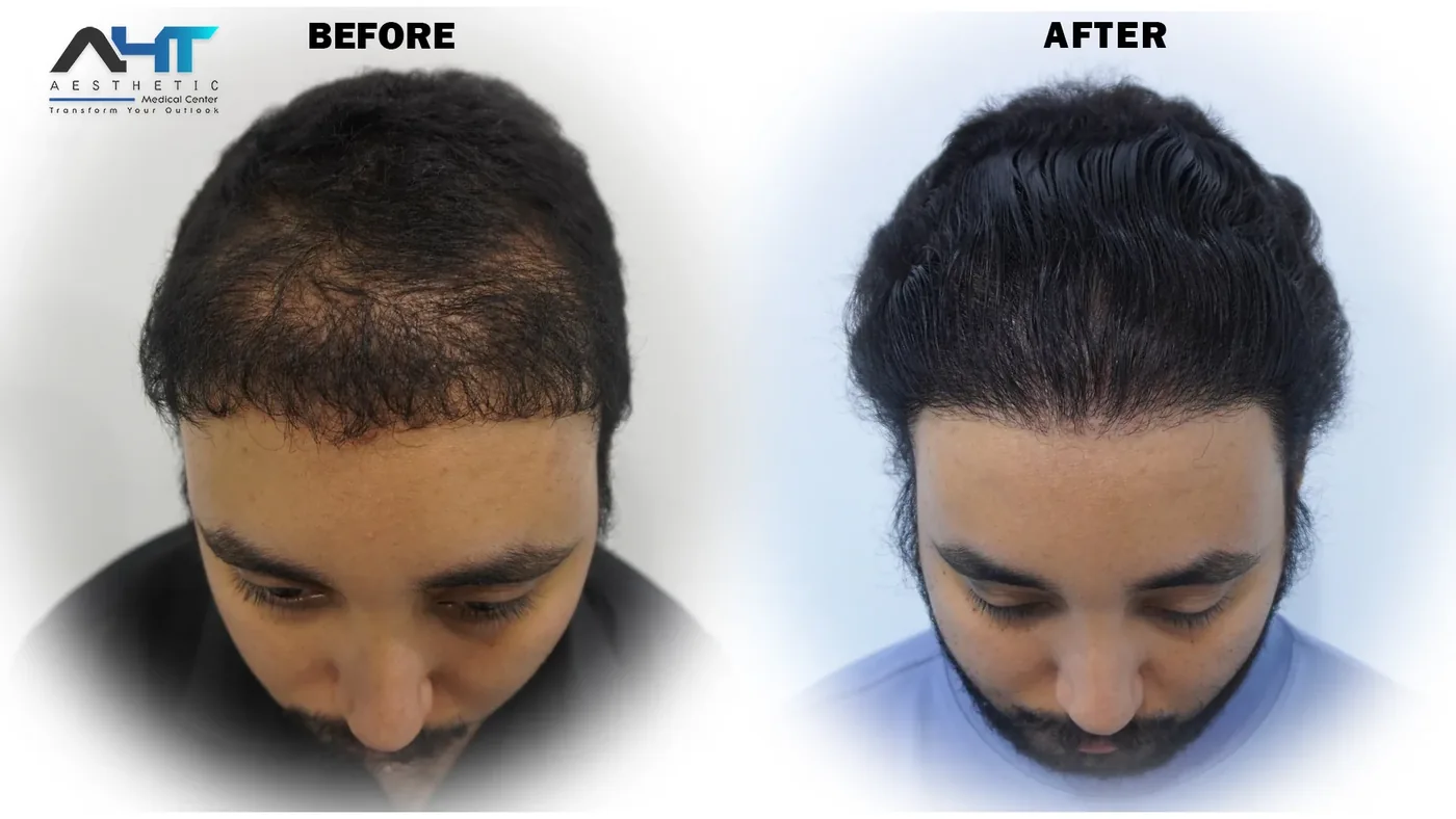 AHT real patient hair transplant result 4