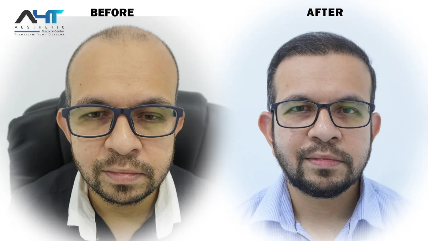 AHT real patient hair transplant result 6