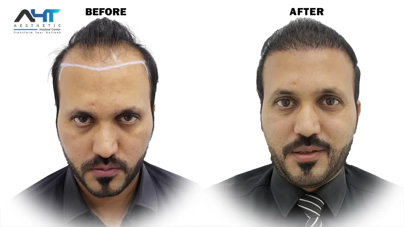AHT real patient hair transplant result 7