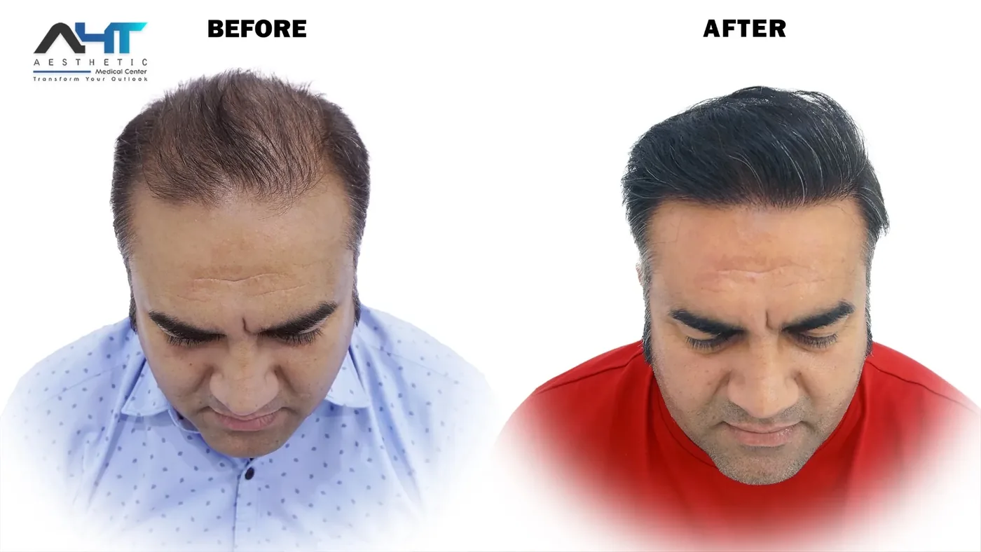 AHT real patient hair transplant result 10