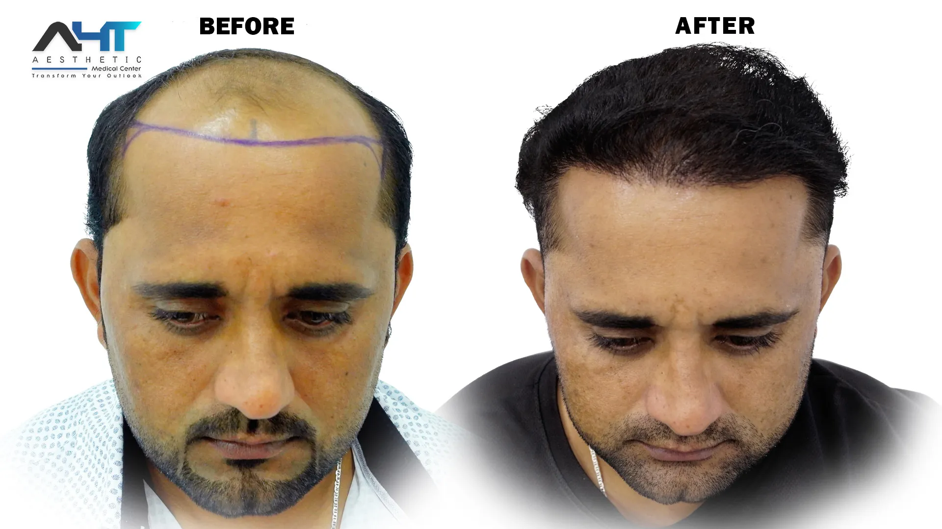 AHT real patient hair transplant result 12