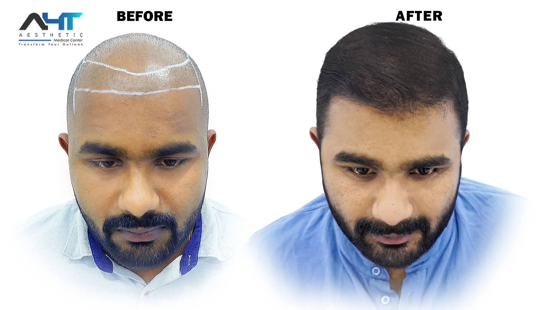 AHT real patient hair transplant result 13