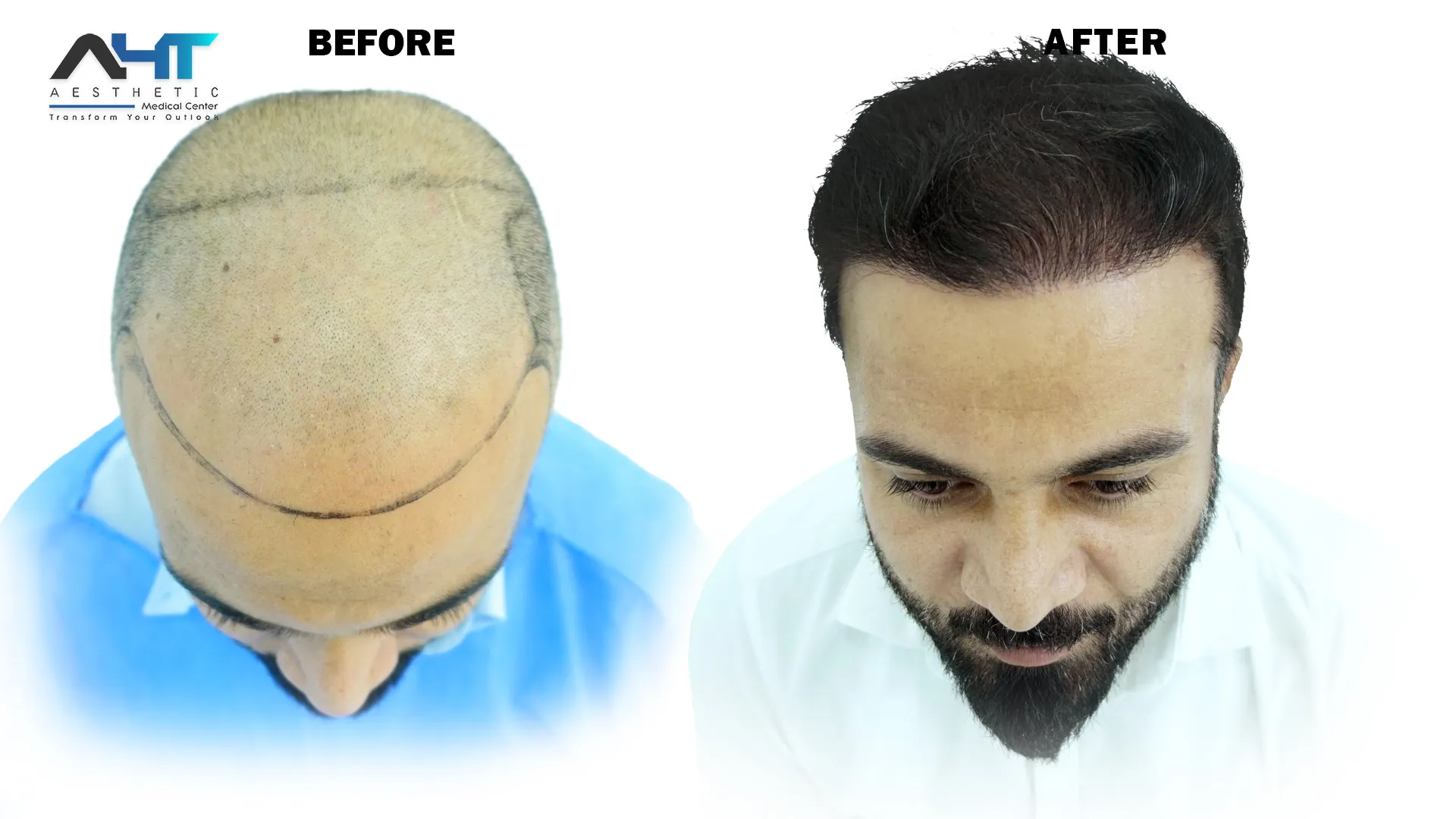 AHT real patient hair transplant result 14