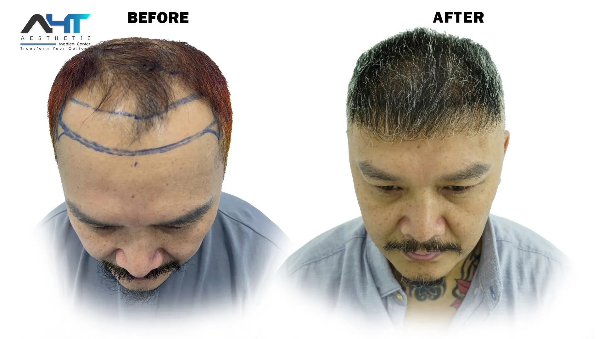 AHT real patient hair transplant result 15