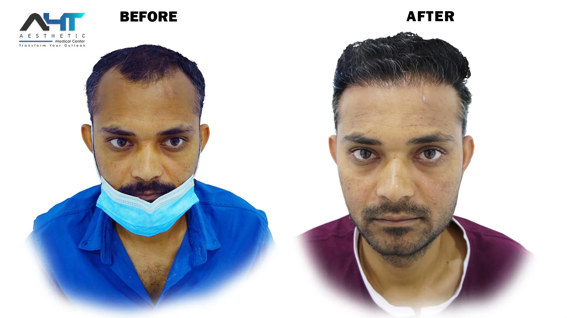 AHT real patient hair transplant result 17