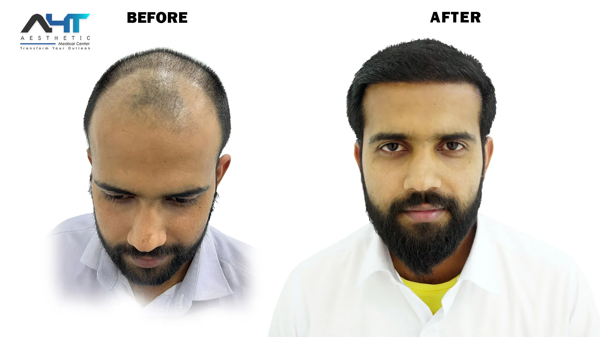 AHT real patient hair transplant result 18