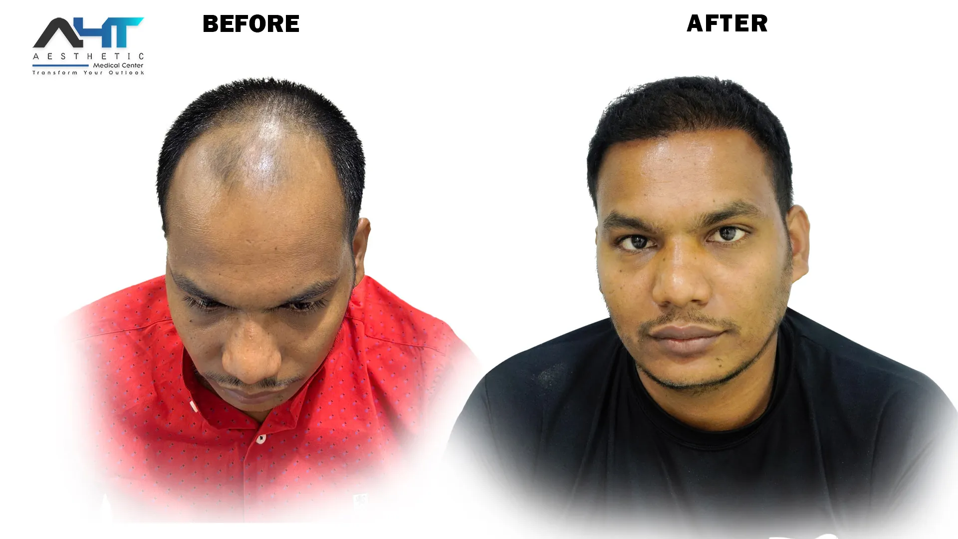AHT real patient hair transplant result 19