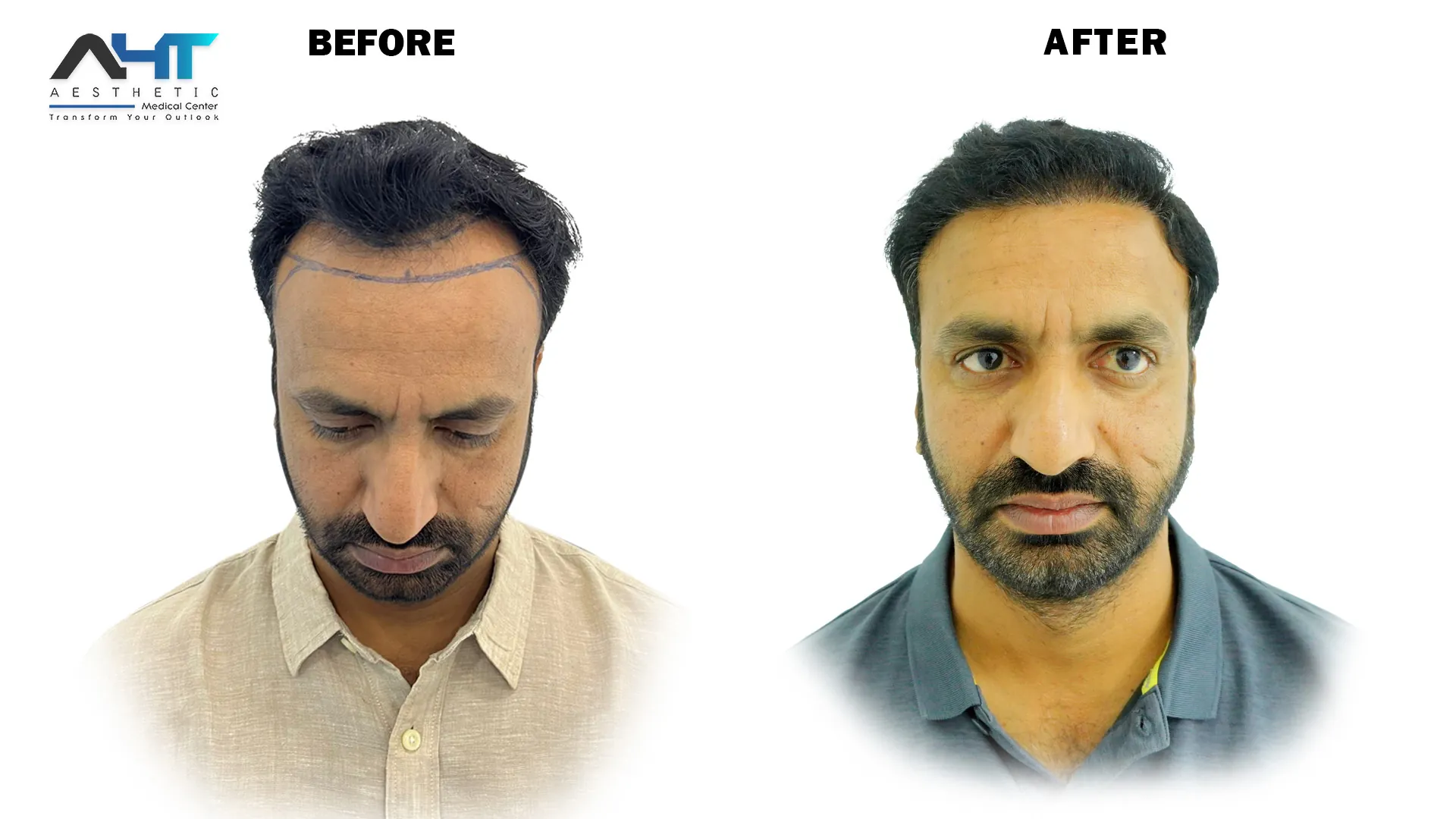 AHT real patient hair transplant result 20