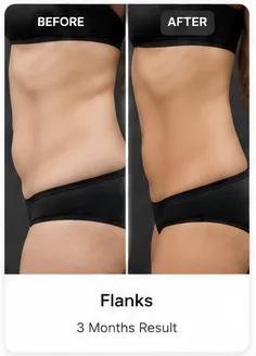 Waist & Abdomen tummy tuck before and after illustrative example
