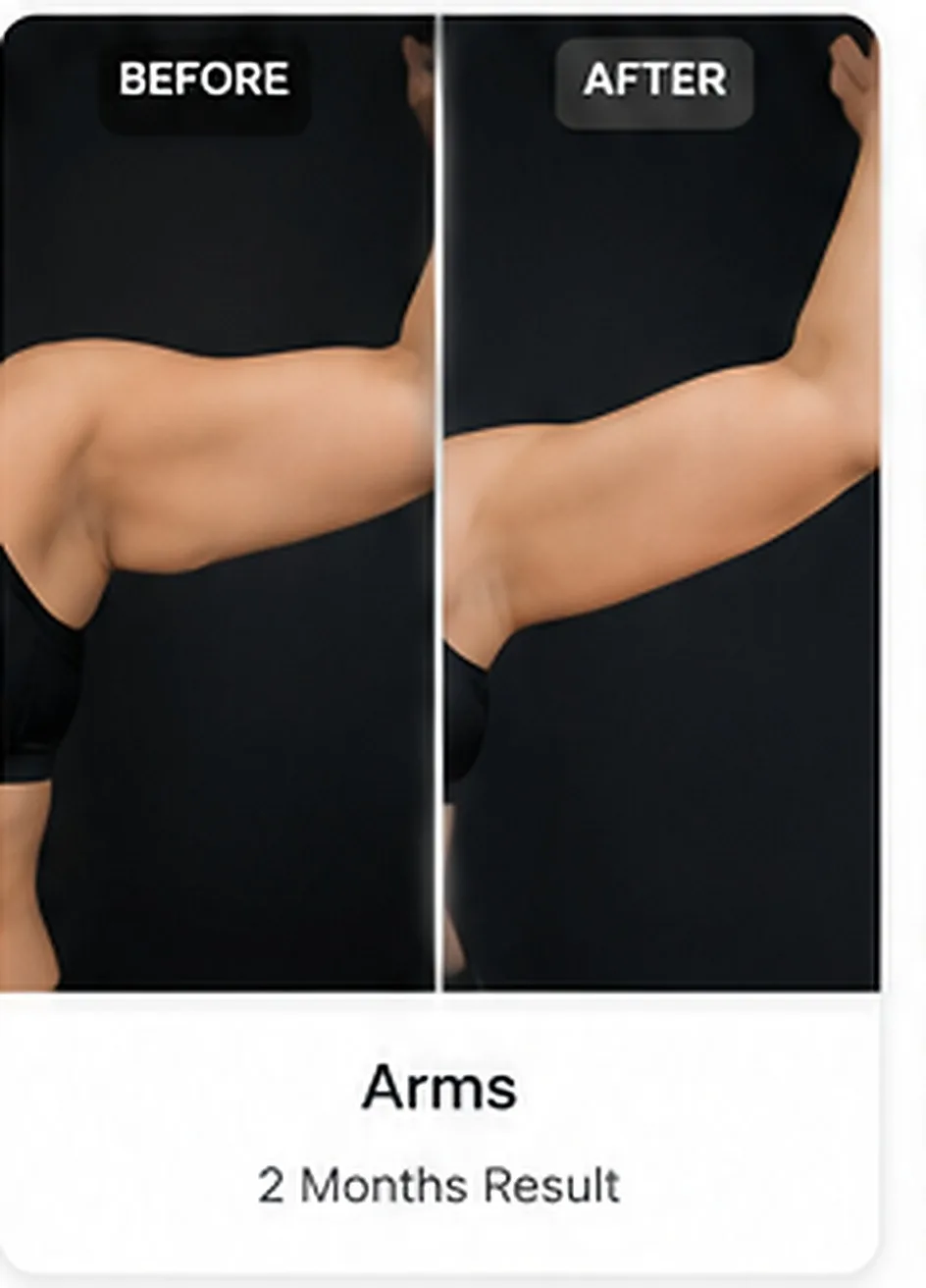 Arms liposuction before and after example
