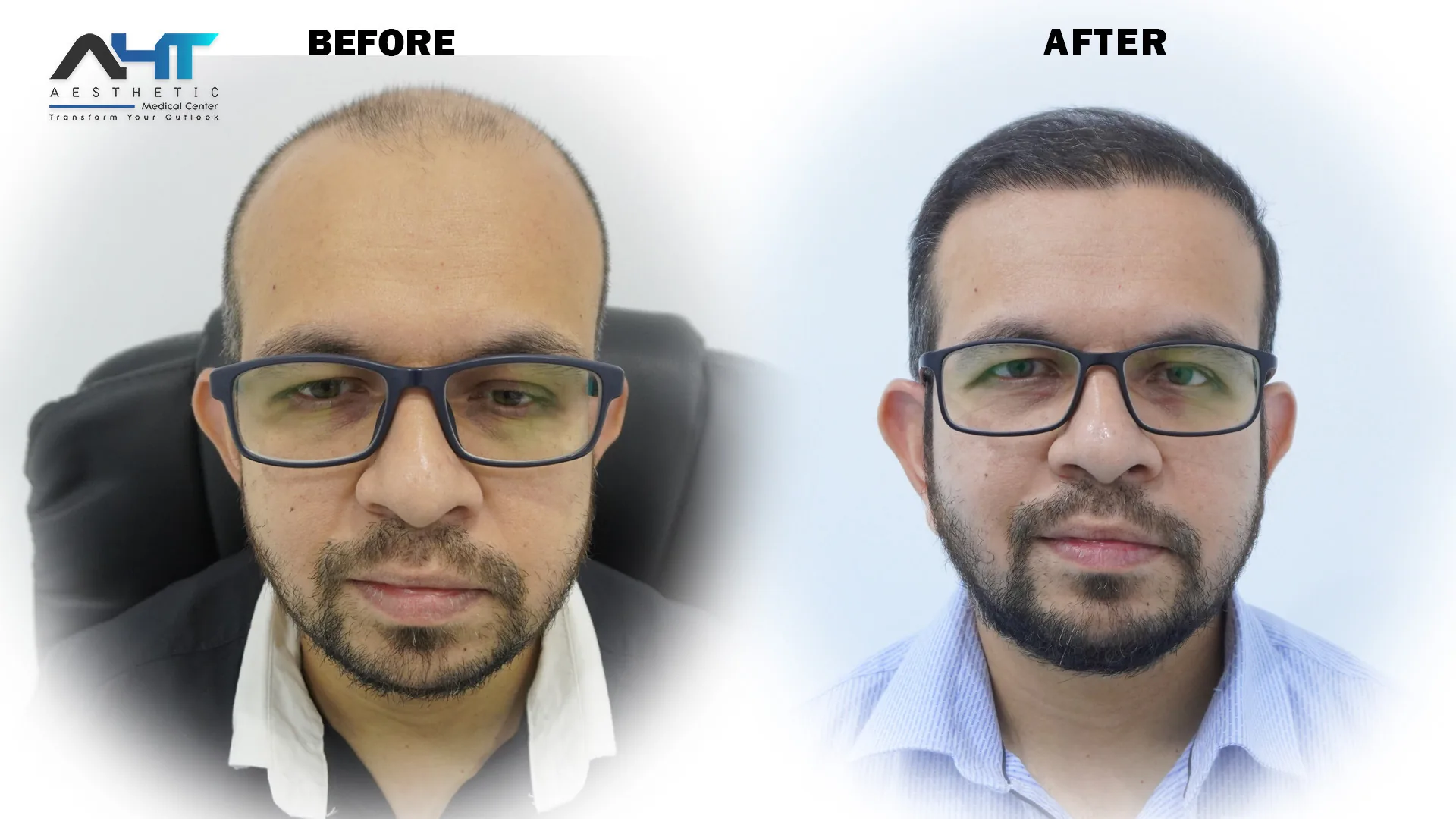 AHT Patient Result 6 before and after