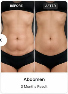 Lower Abdomen tummy tuck before and after illustrative example