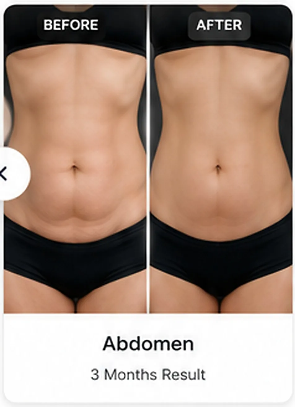Abdomen liposuction before and after example