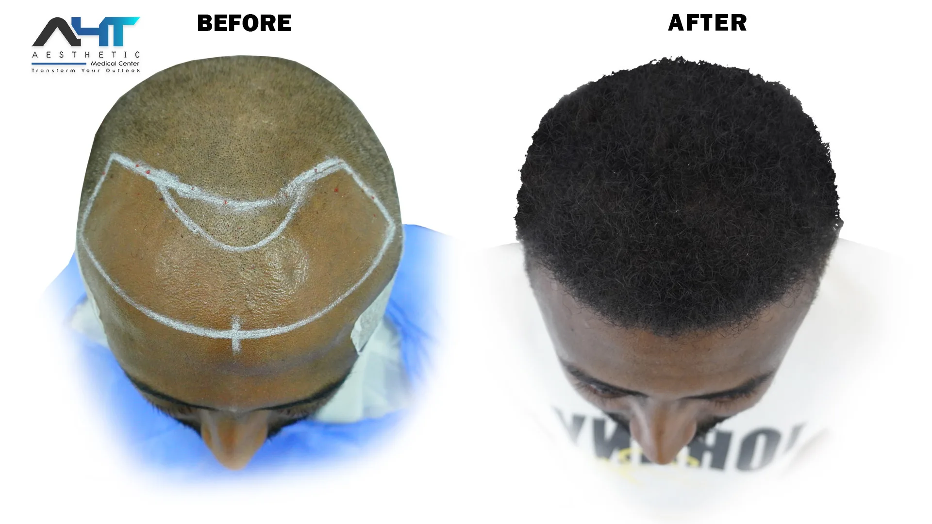 AHT Patient Result 5 before and after