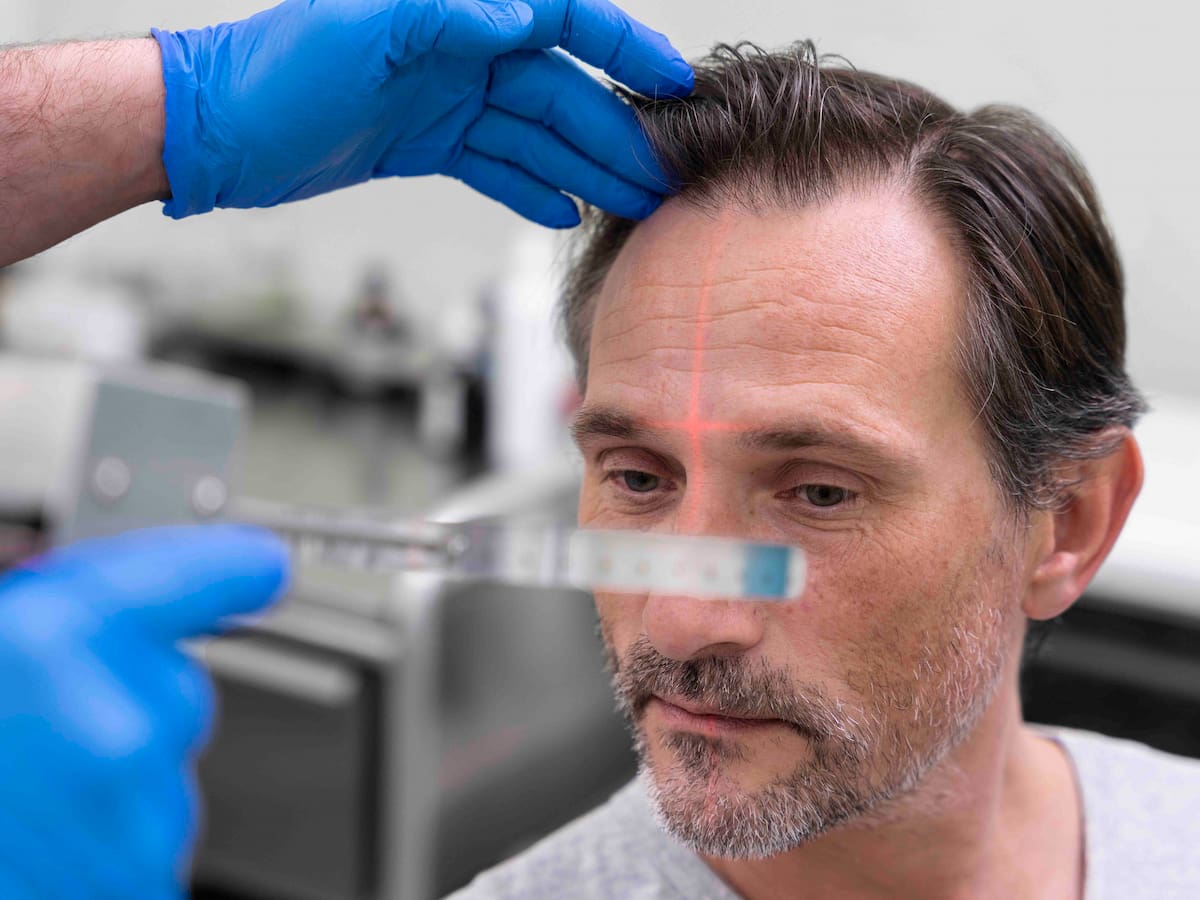 A man who advised a hair transplant with a laser guide to measure the skull.