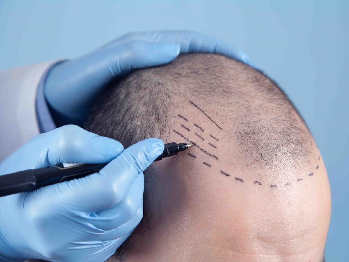 A doctor is marking the patient's skull during a hair transplant advice.
