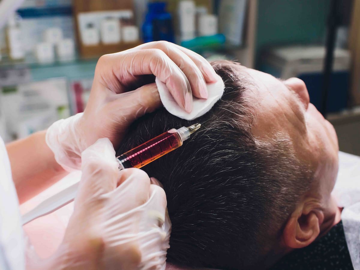 A cosmetologist administering a plasma lifting treatment on a male patient to address hair loss.