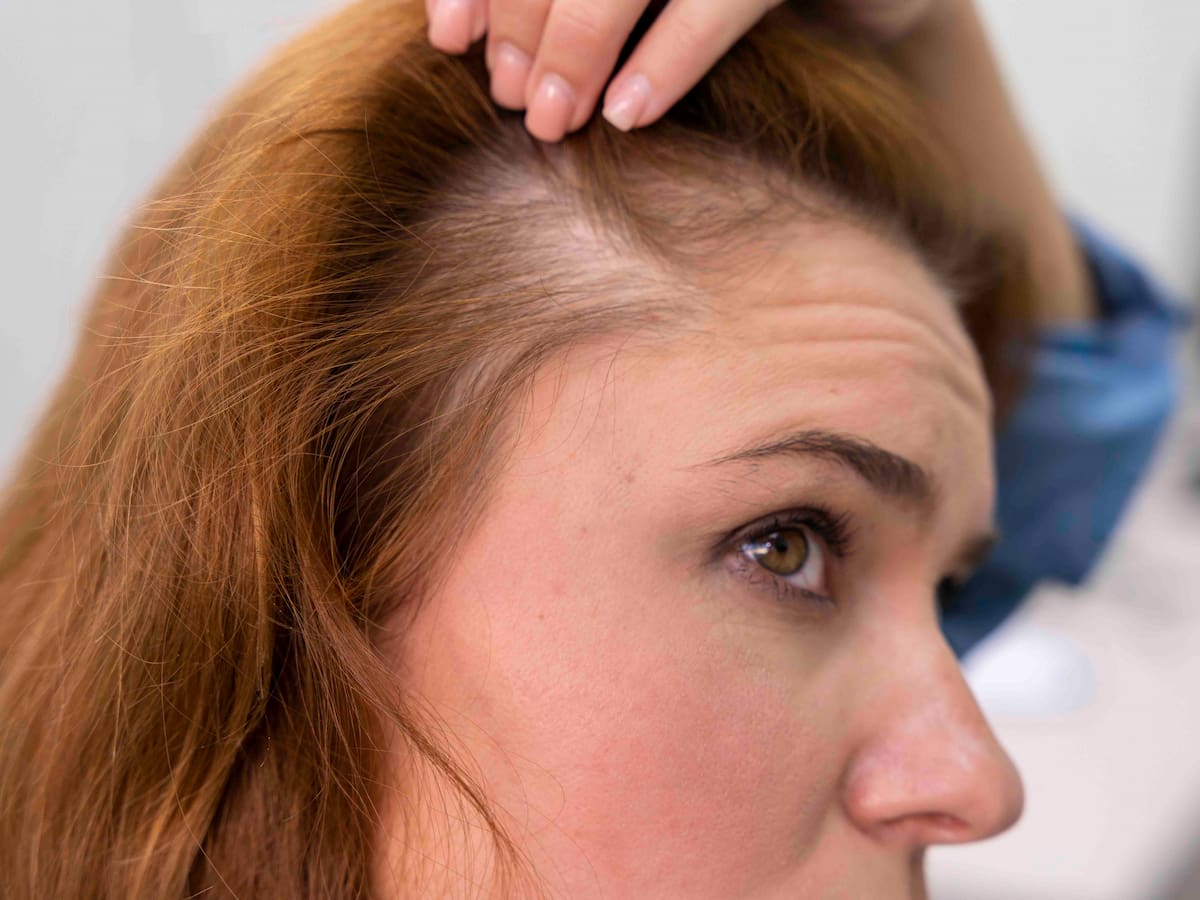 A woman examining her thinning hair, possibly experiencing hair loss, is thinking of hair transplant.