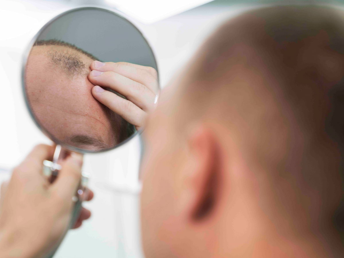 Patient examining scalp in mirror after FUE hair transplant procedure