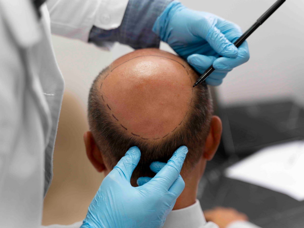 Doctor marking donor area on a patient's scalp during FUT hair transplant procedure.