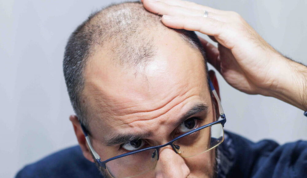 What is FUT Hair Transplant?