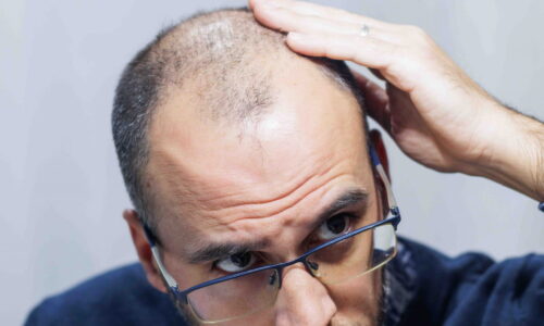 What is FUT Hair Transplant?