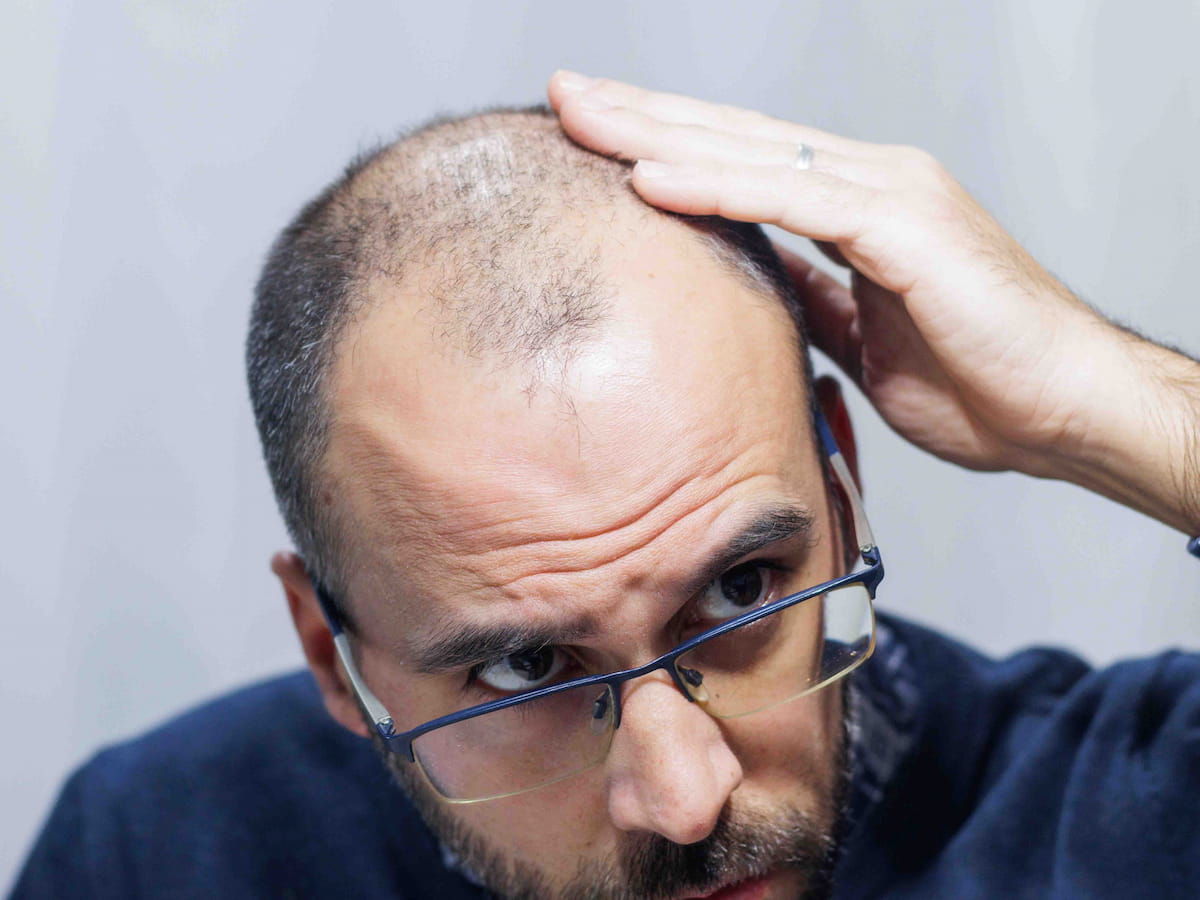 A mature man physically examining his bald scalp thinking about his hair fall, having a question in mind "What is a FUT Hair Transplant?"