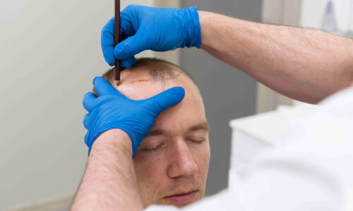 How many sessions of prp are required after hair transplant?