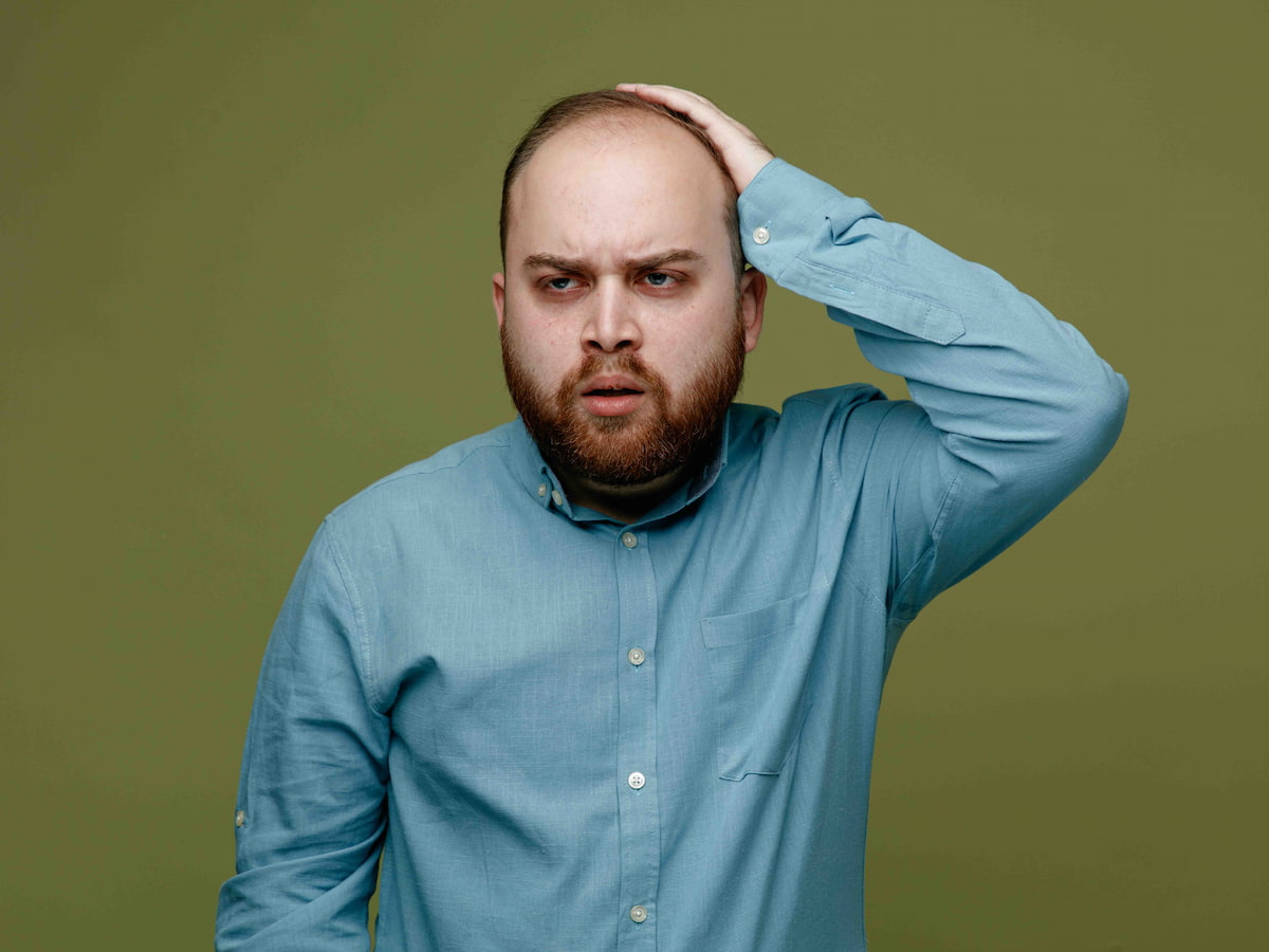 A man showing patchy and uneven hair growth after hair transplant failure.