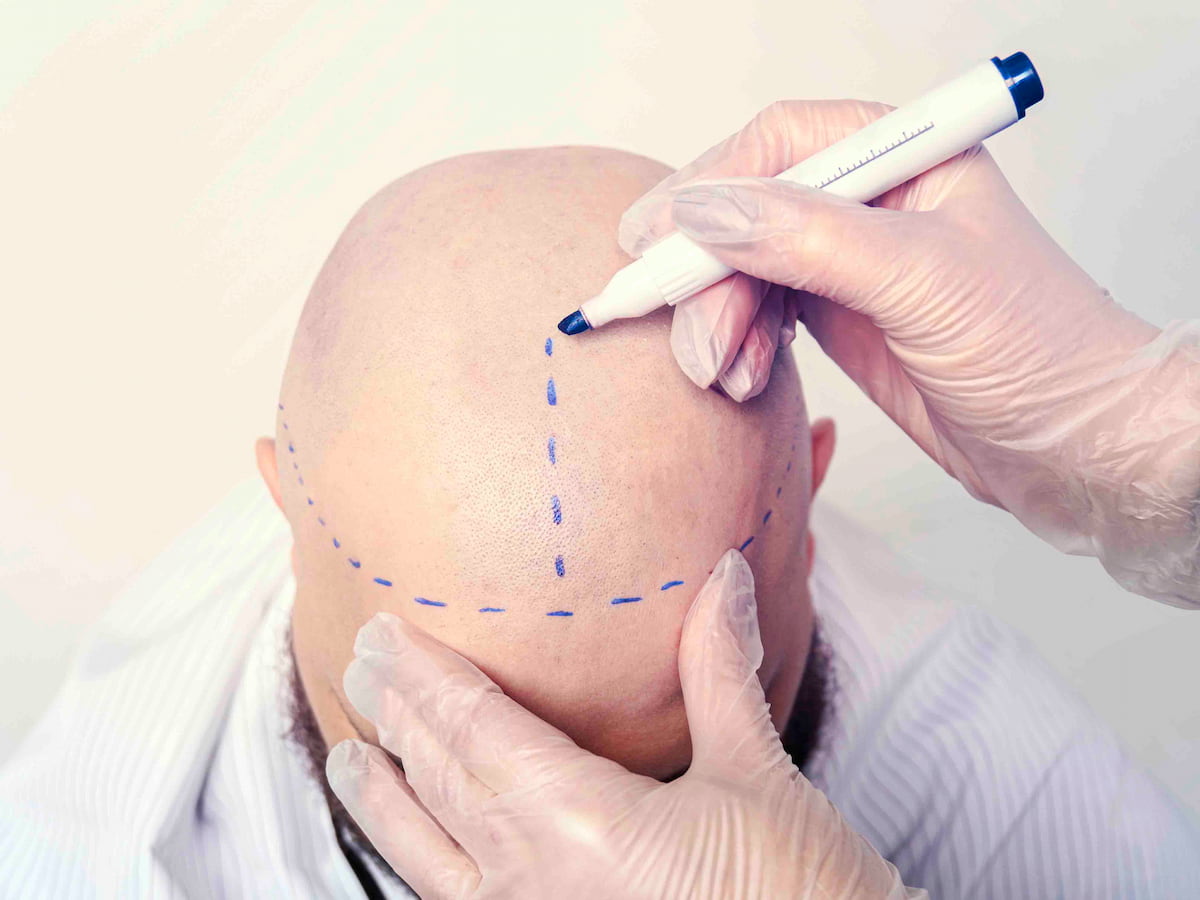 A healthcare physician marks a patient's scalp with a blue marker in preparation for a hair transplant surgery.