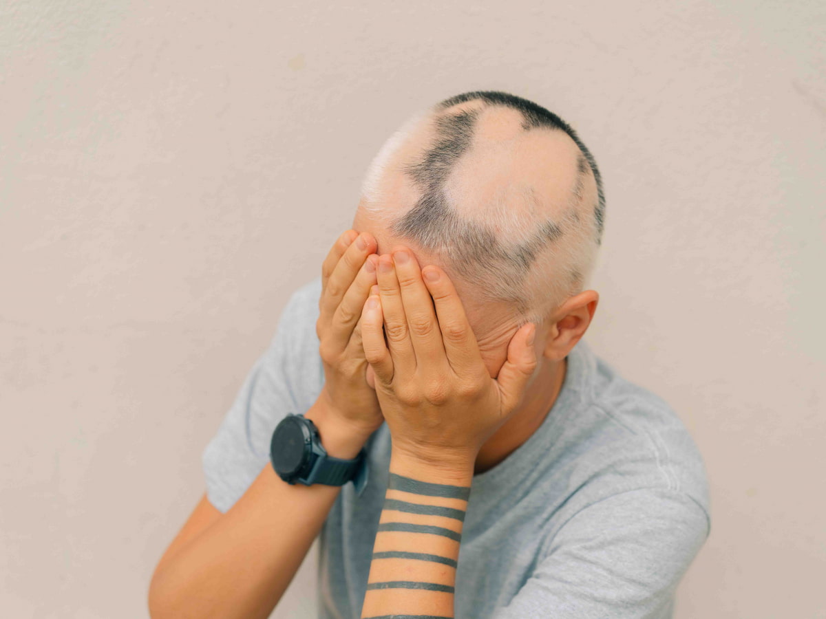 A person with a shaved head, showing visible hair transplant marks, is covering their face in distress, possibly due to complications or infection after the procedure.