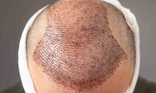 What Happens to Donor Area After Hair Transplant?