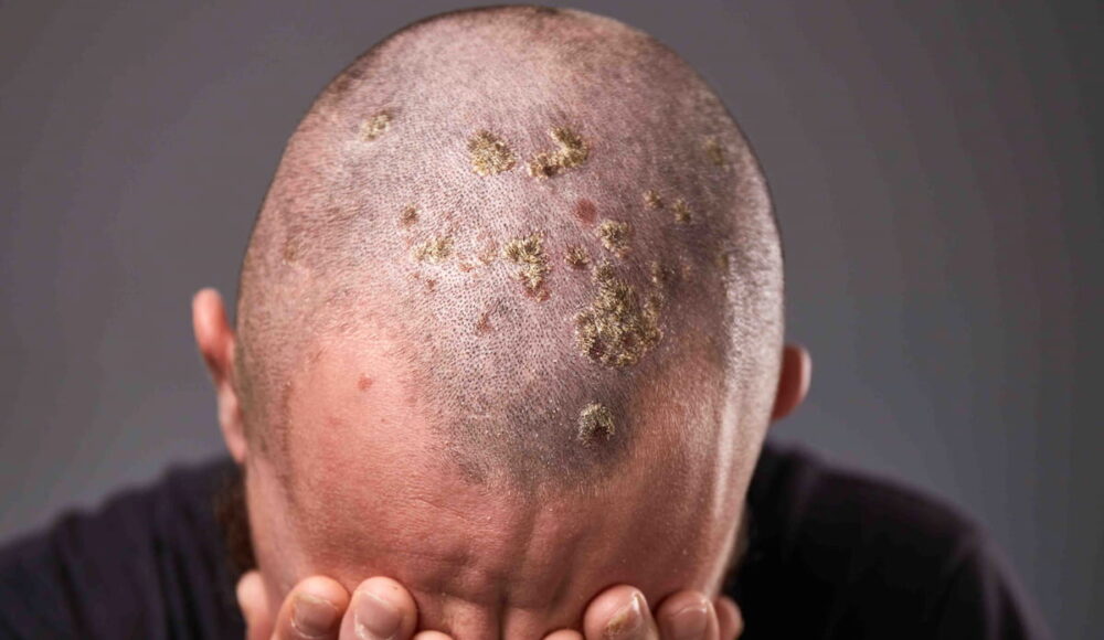 How Long Do Scabs Last After Hair Transplant?