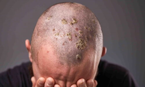 How Long Do Scabs Last After Hair Transplant?
