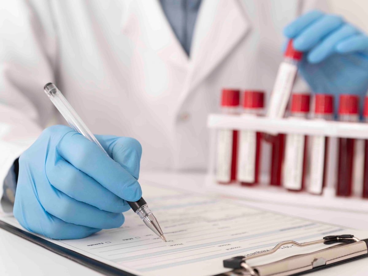 Doctor writing on medical report with blood samples in test tubes, showing what tests are done before hair transplant.