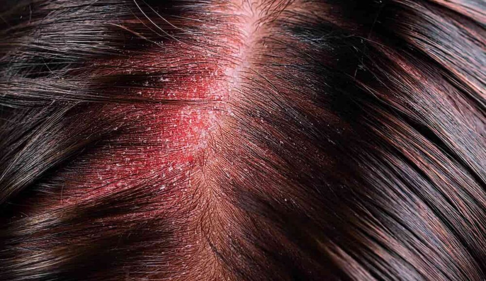 How to Get Rid of Redness After Hair Transplant?