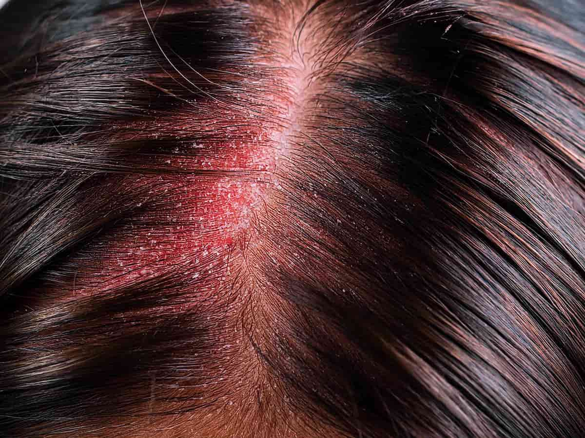 Close-up of scalp redness and discussing how to get rid of redness after hair transplant.