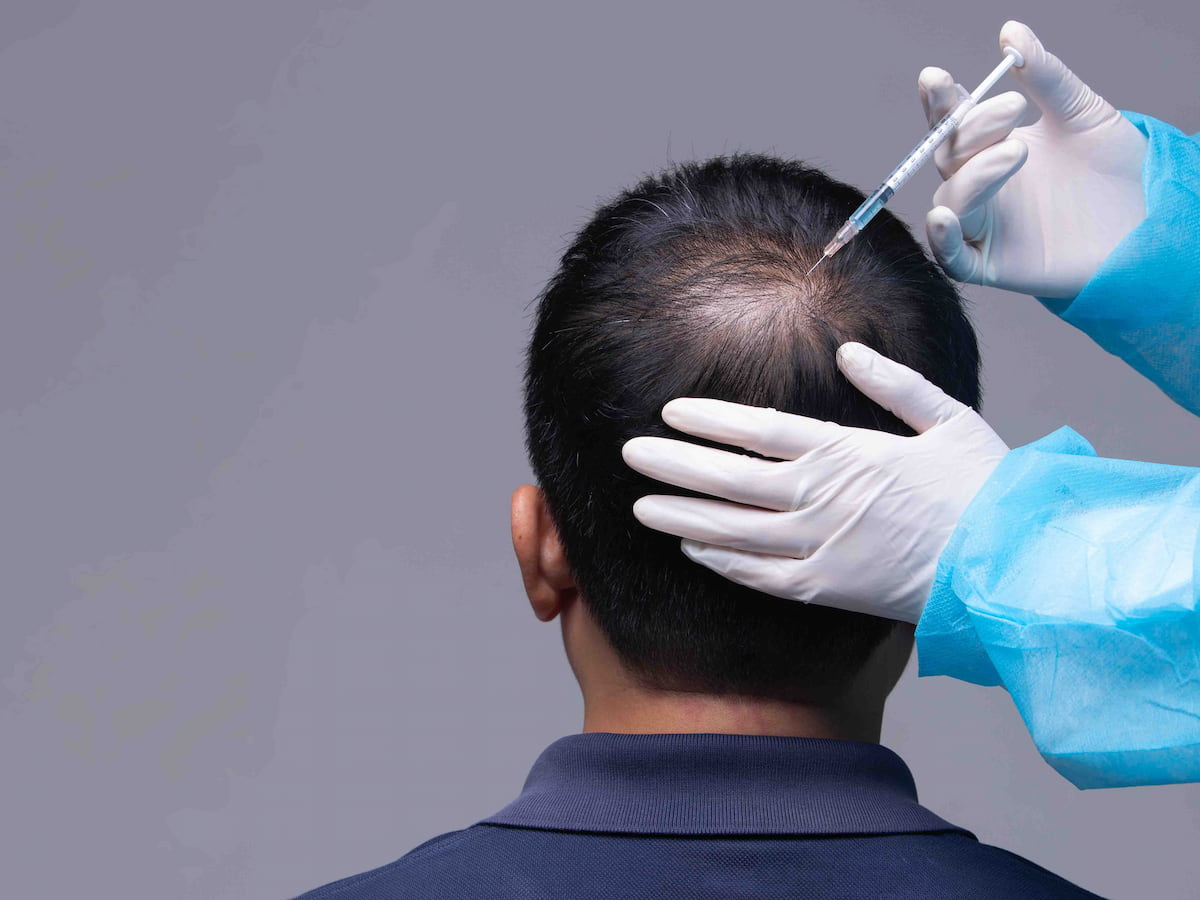 Doctor injecting treatment to increase hair density after hair transplant in a patient with thinning crown.