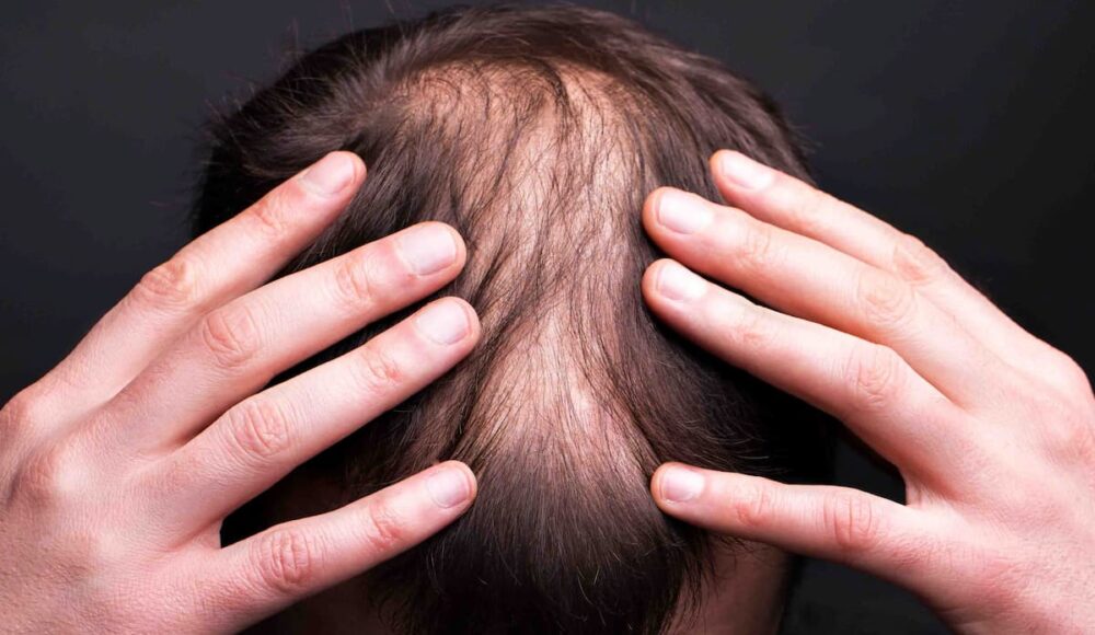 How Long to Wait for Second Hair Transplant?