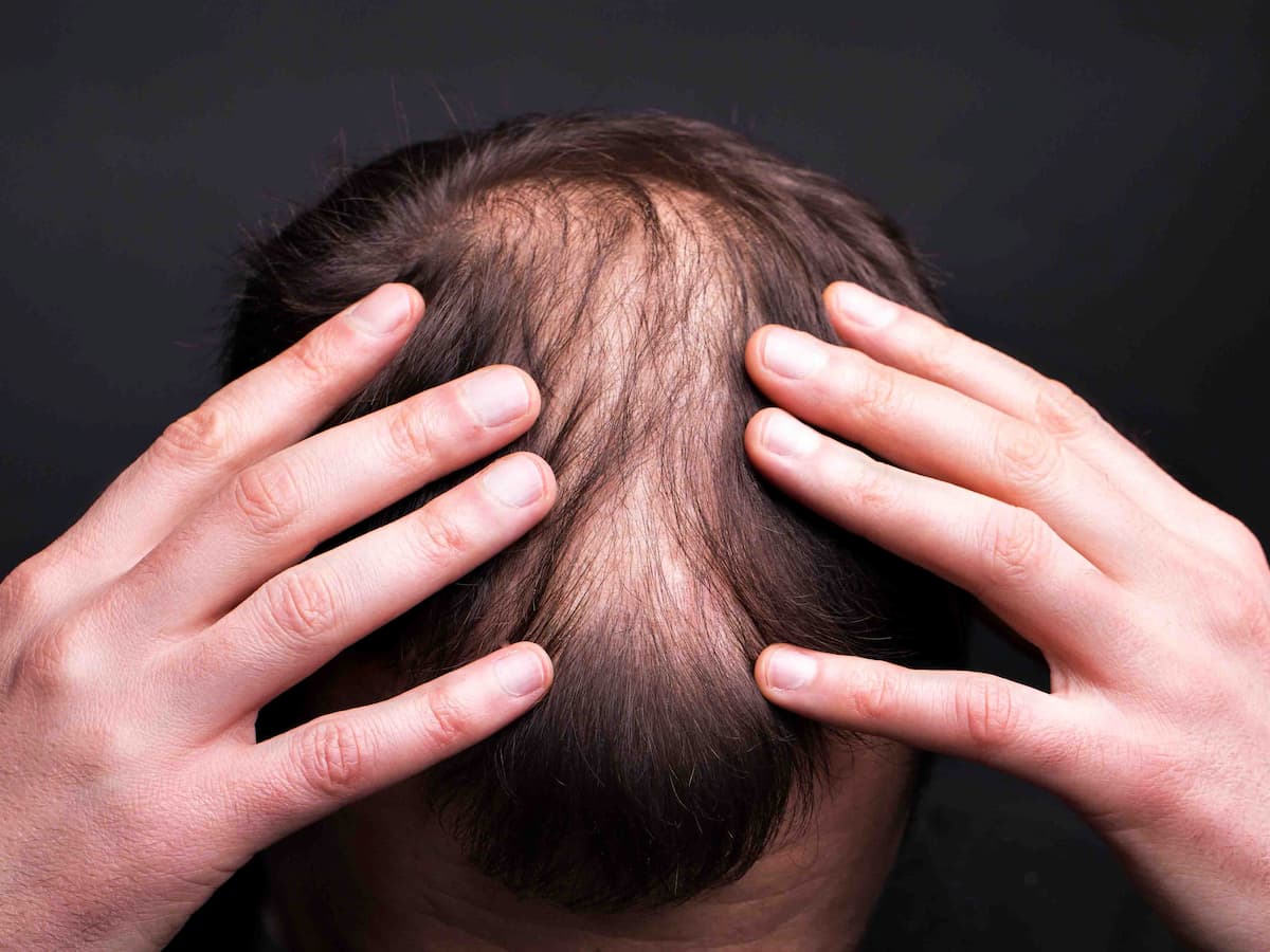 A man with visible bald spots holding his head, illustrating hair loss concerns and the need to know how long to wait for second hair transplant.