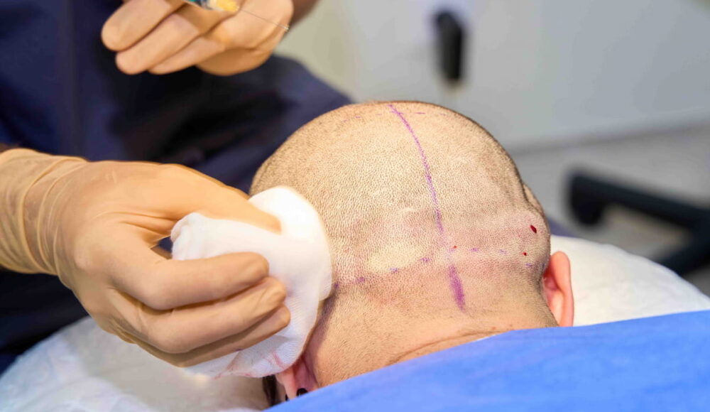 How to heal donor area after hair transplant?