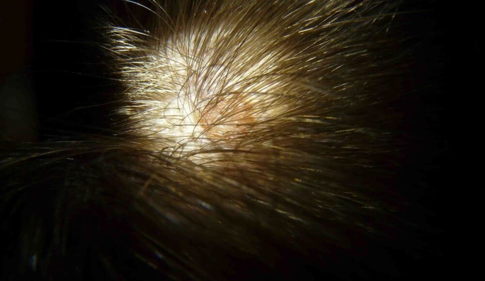 What To Do For Pimples After Hair Transplant?