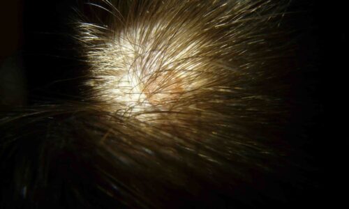 What To Do For Pimples After Hair Transplant?