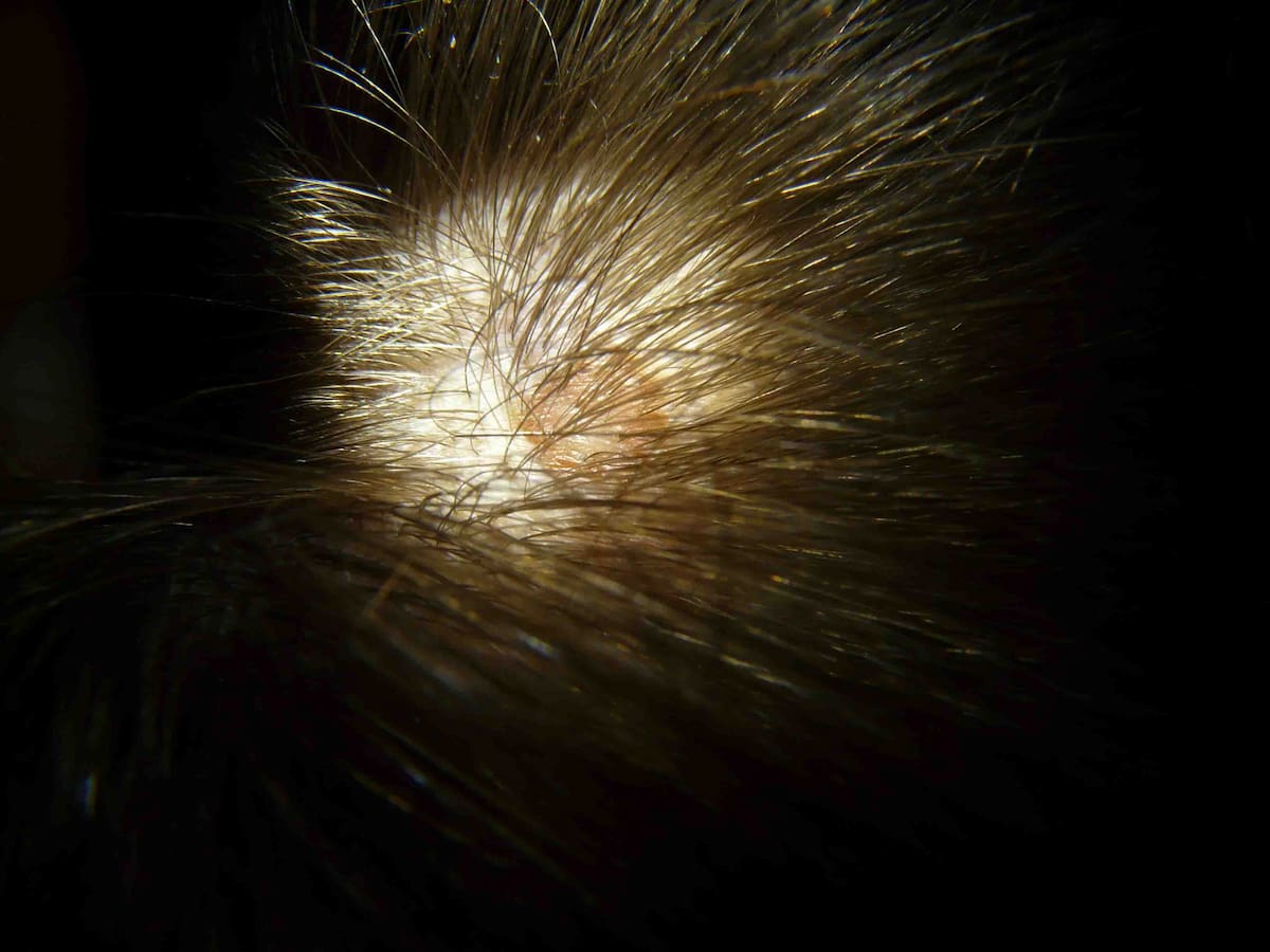 Close-up image of a pimples after hair transplant, showing irritation and early folliculitis.