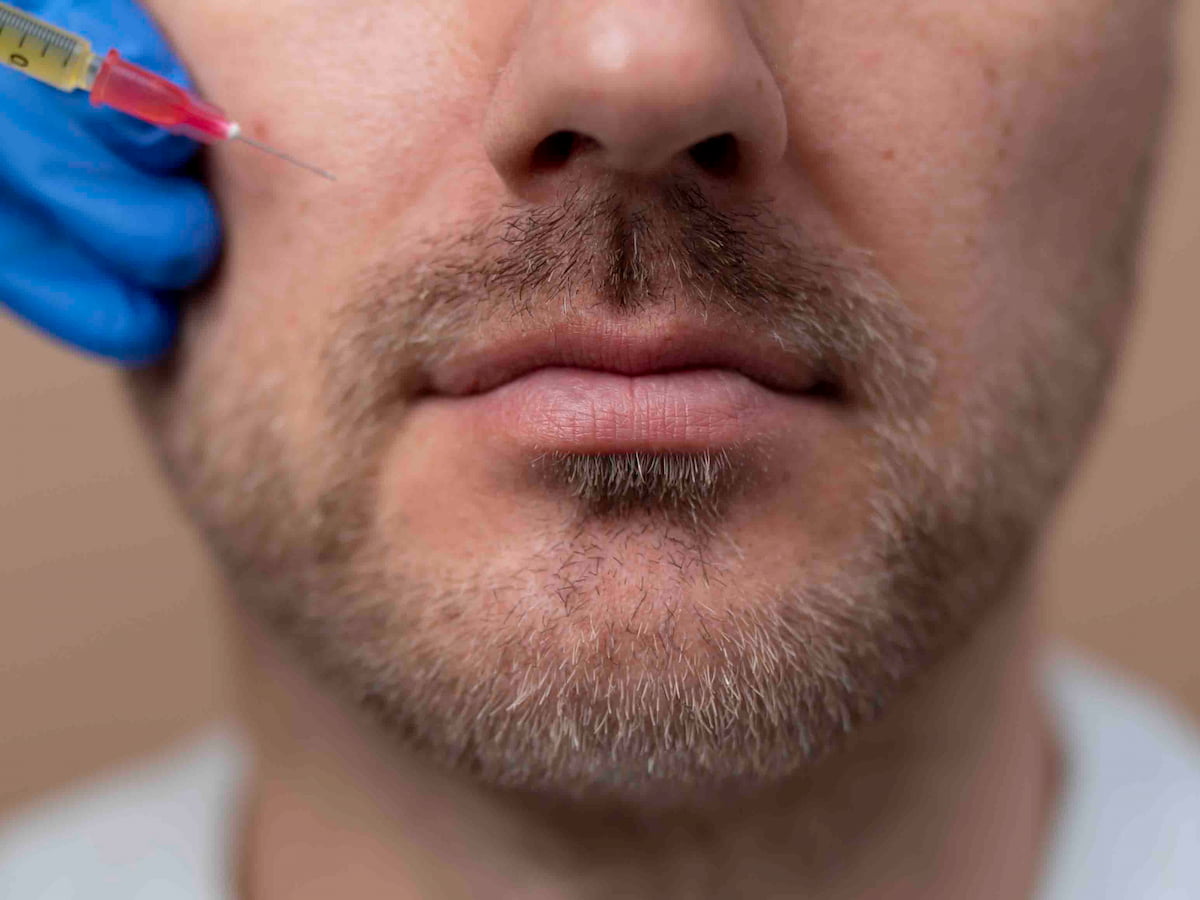Close-up view of a man undergoing mustache hair transplant in Dubai with a syringe preparing the treatment area.