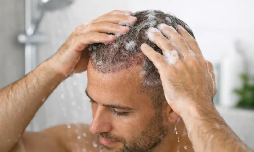How to Wash Transplanted Hair Safely
